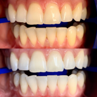 Teeth Whitening - Cosmetic Dentistry North Haven