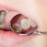 Preventative dentistry - sealants